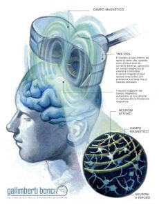 Stimolazione magnetica transcranica (TMS) - Gallimberti Bonci