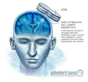 Stimolazione magnetica transcranica (TMS) - Gallimberti Bonci