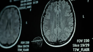 Risonanza magnetica del cervello con immagini dettagliate delle sezioni cerebrali.